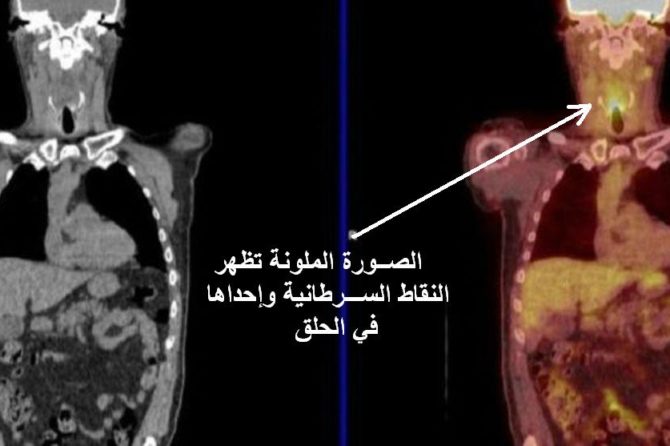 المسح الإشعاعي ربما يساعد على تجنب عمليات جراحية خطرة لمرضى السرطان