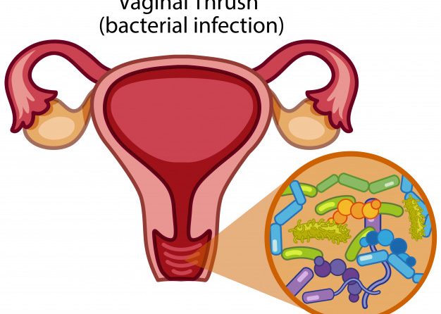 الافرازات المهبلية. VAGINAL DISCHARGE