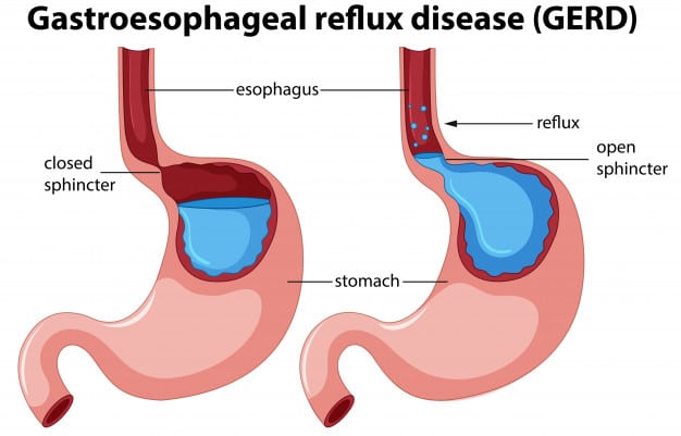Gastroesophageal reflux disease
