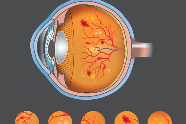 Diabetic Retinopathy