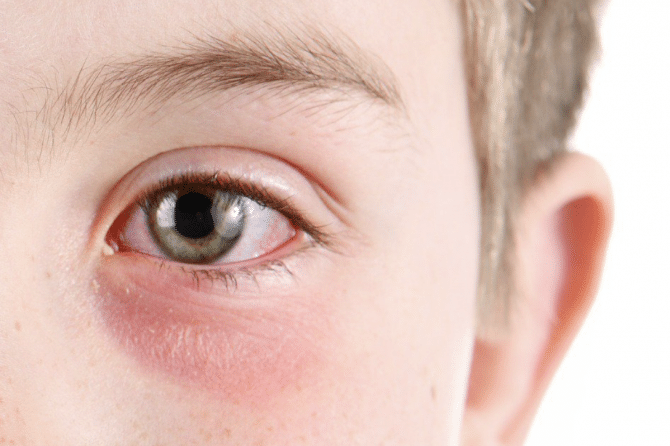 جفاف العين..الأعراض وطرق العلاج
